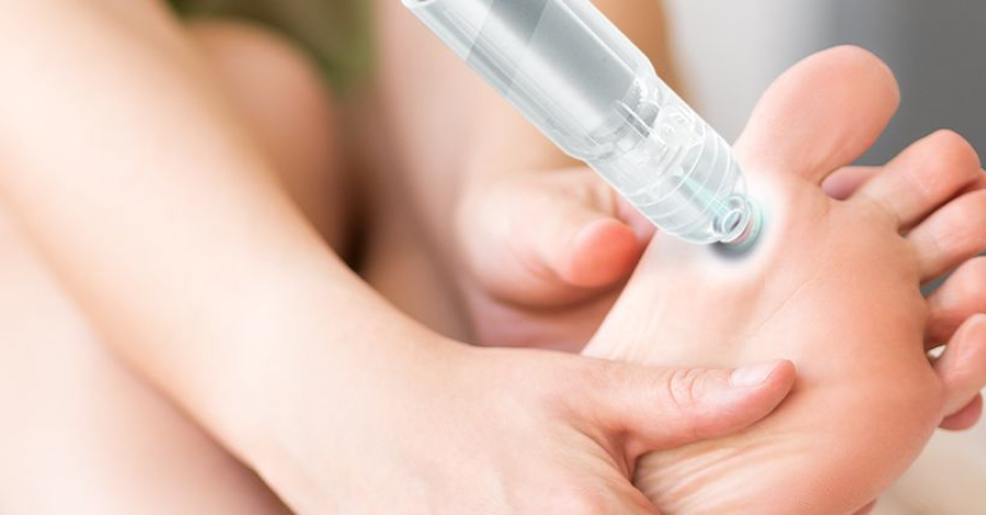 azoto liquido e verruche Verruca plantare trattata con azoto liquido o crioterapia., L’azoto è un  gas incolore e inodore che allo stato liquido raggiunge la temperatura di  circa main image 0